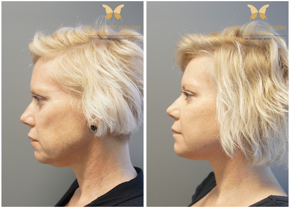 Before and after facelift 22, left side view, Dr Chaithan Reddy