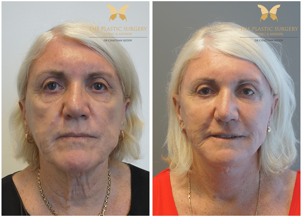 Before and after gallery , face and neck lift 23, female patient, front view