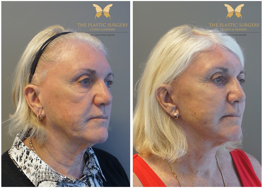 Before and after face and neck lift 24, Dr Reddy Sydney