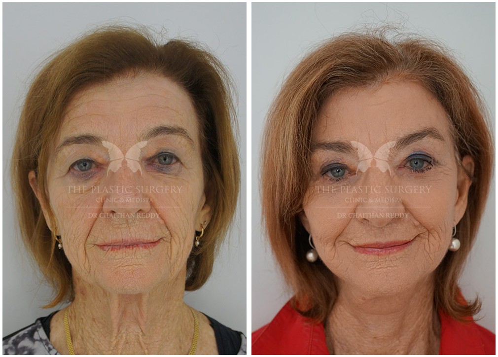 Patient before and after facelift and neck lift 29, front view