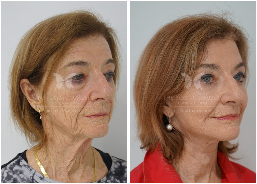 Female patient before and after facelift and neck lift 30, TPSC
