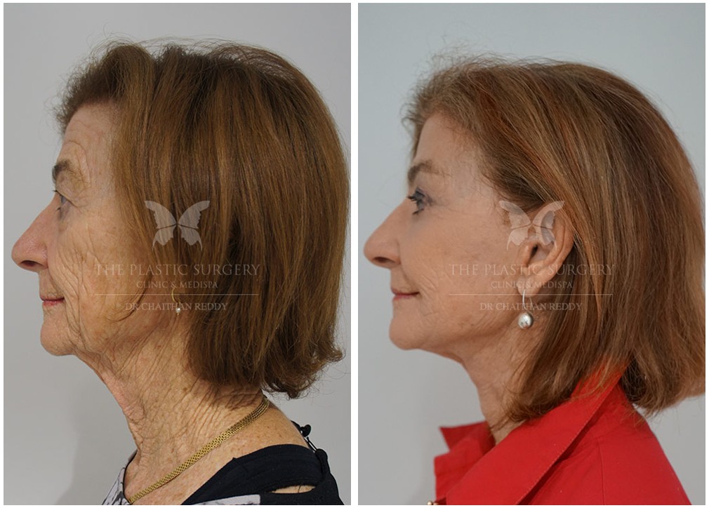 Before and afters 33, facelift and neck lift surgery, Dr Reddy Sydney