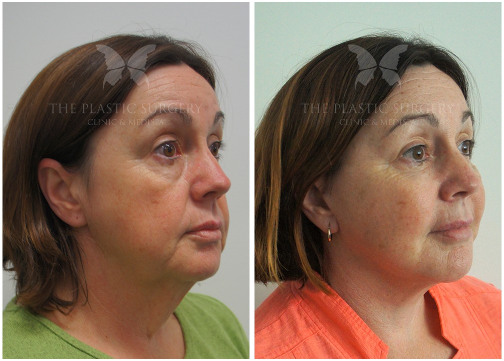 Face and neck lift before and after 35