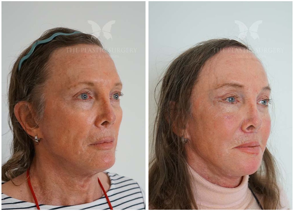 Patient before and after facial fat transfer 07, Dr Reddy