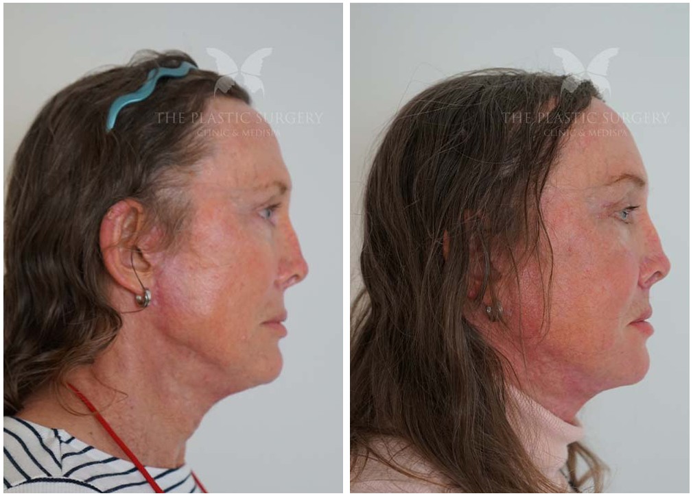 Before and after facial fat transfer 08, Dr Reddy