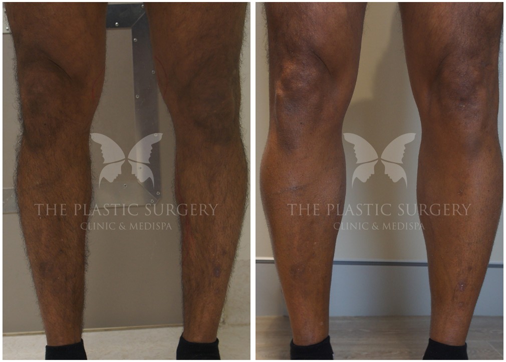 Leg fat grafting (fat transfer) before and after 01, The Plastic Surgery Clinic