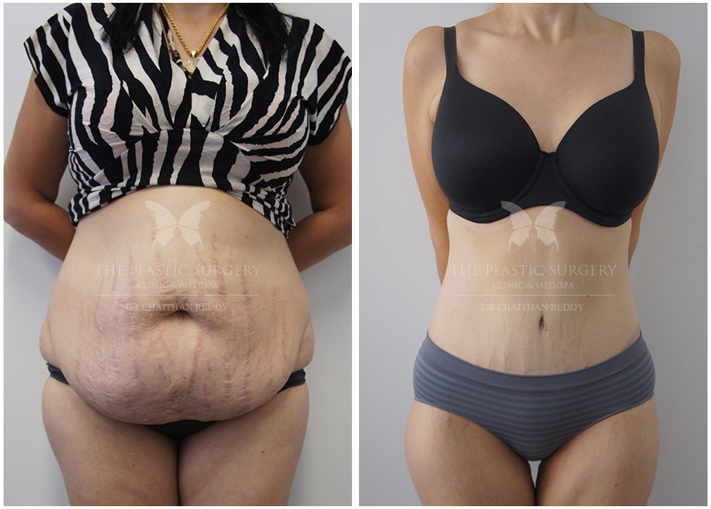 Before and after 06, mummy makeover surgery patient, Dr Reddy