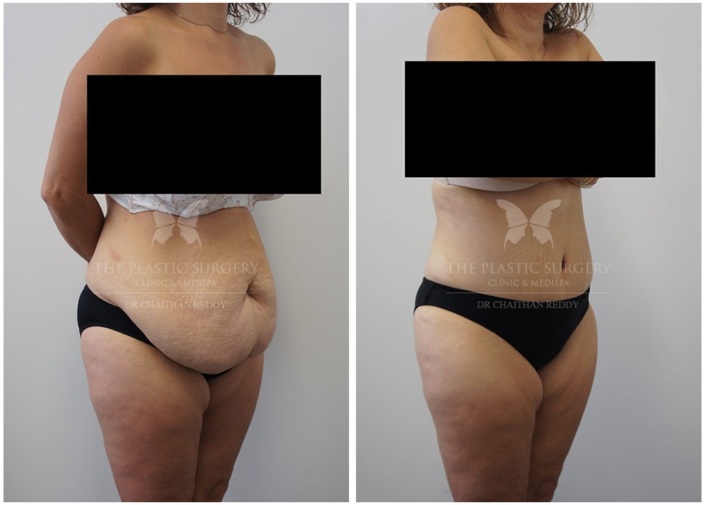 Dr Reddy mummy makeover patient, before &amp; afters 10, angle view