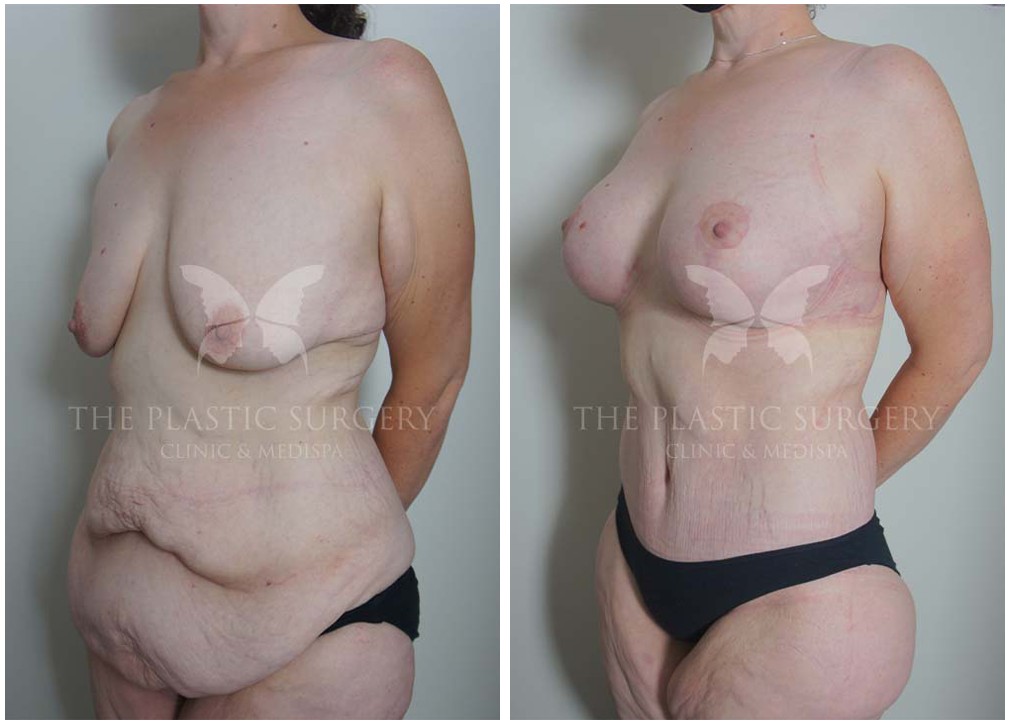 Before and after mummy makeover surgery 17, Dr Reddy