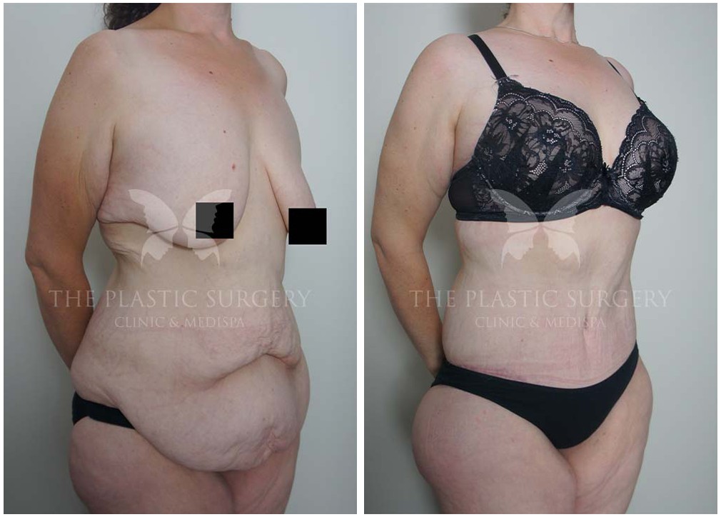 Body lift and post weight loss surgery before and after 02, Dr Reddy Sydney, angle view
