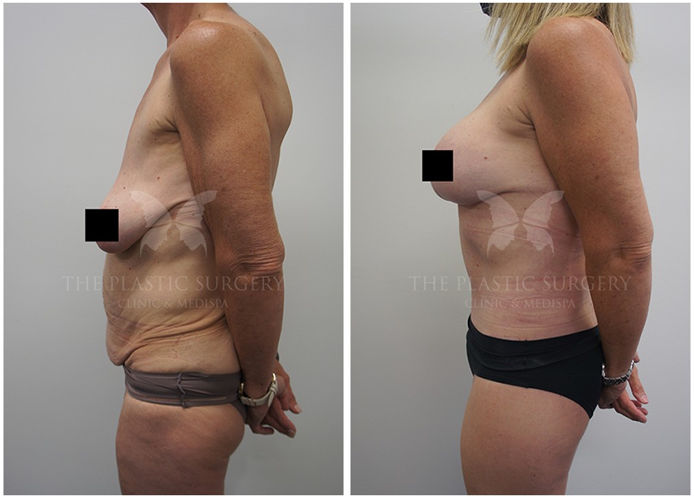 Patient before and after post weight loss surgery at The Plastic Surgery Clinic in Sydney 09, side view