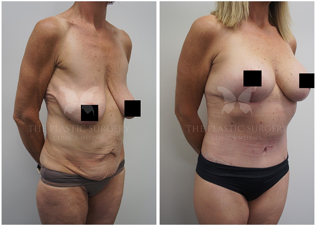 Post weight loss surgery before and after 10, Dr Chaithan Reddy
