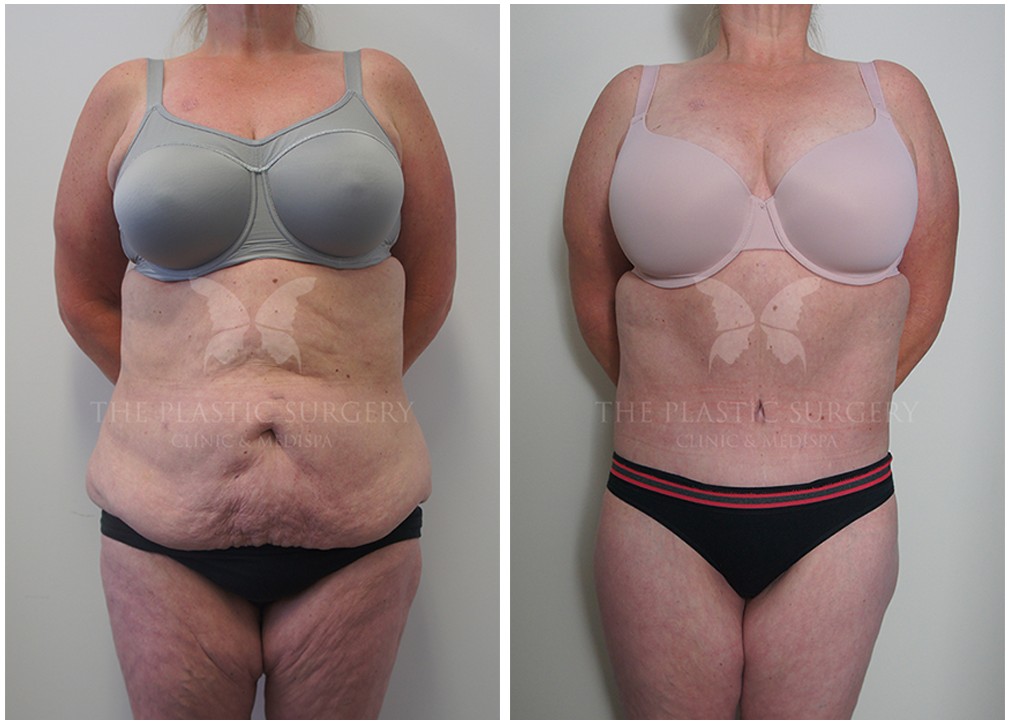 Post weight loss surgery before and after 12, Dr Reddy, front view