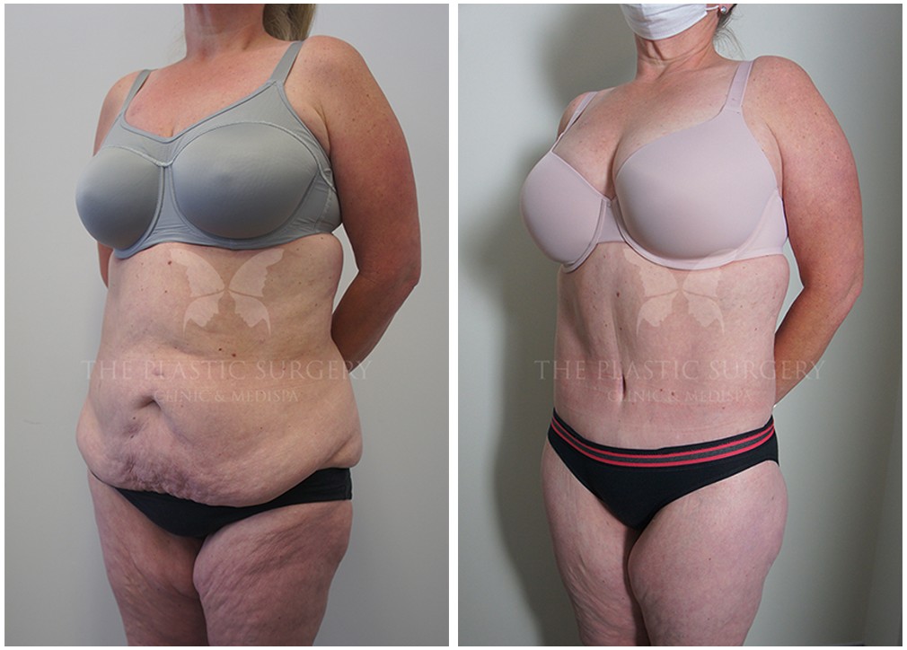 Patient before and after post weight loss surgery 15, angle view