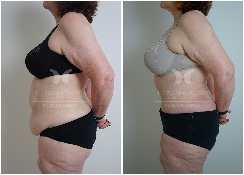 Patient before and after 19, post weight loss &amp; body lift gallery, Dr Reddy