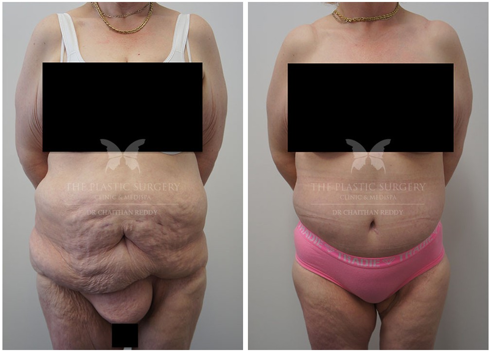Post weight loss surgery before and after 20, The Plastic Surgery Clinic