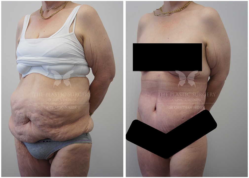 Patient before and after post weight loss &amp; body lift surgery 21