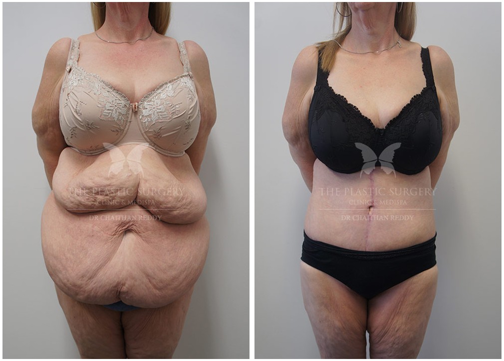 Dr Reddy, post weight loss surgery before and after 31, front view