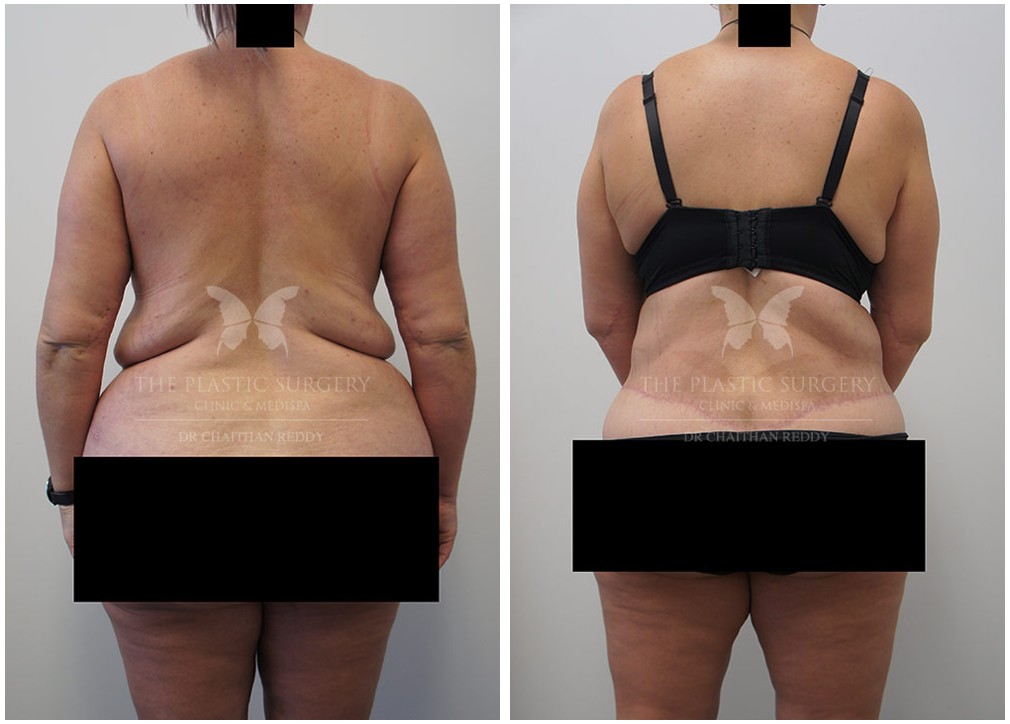 Before and afters 38, post weight loss surgery, Dr Reddy Sydney &amp; Central Coast