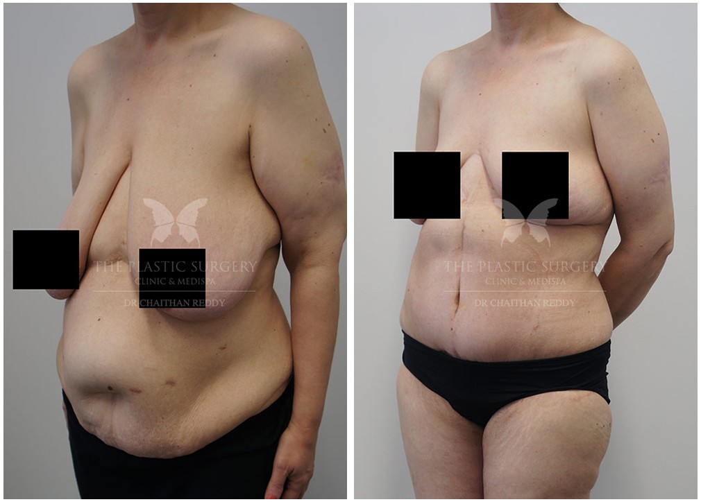 Patient before and after post weight loss surgery 42, Dr Reddy