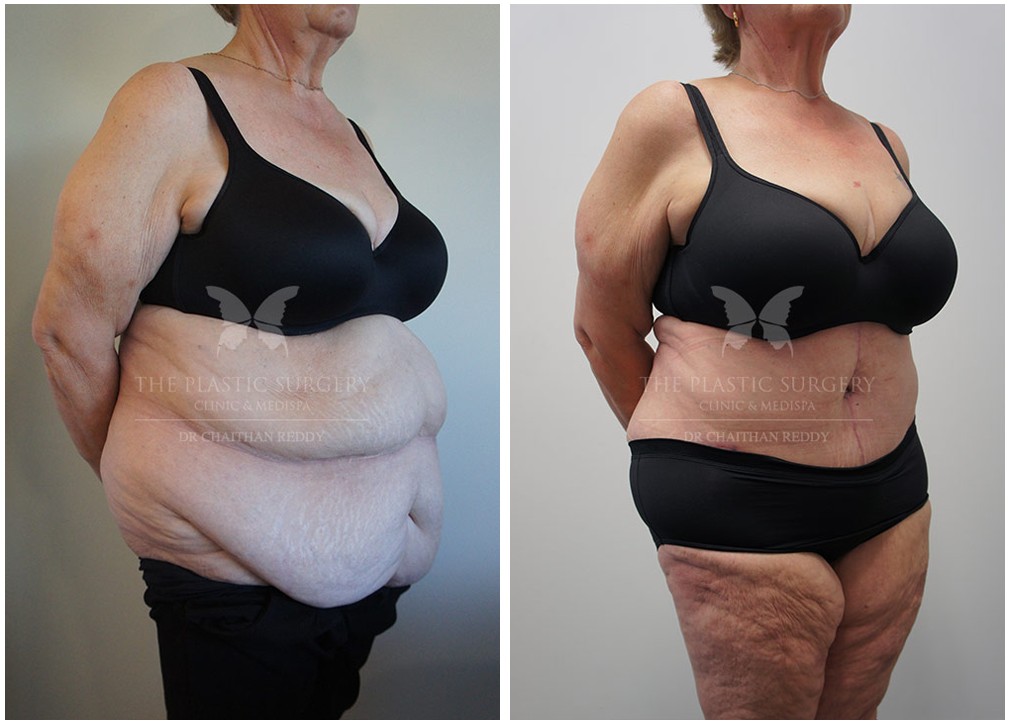 Female patient before and after post weight loss surgery 45, angle view, Dr Reddy