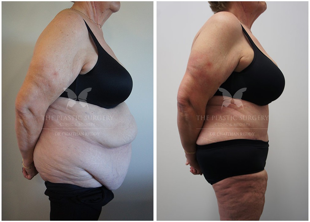 Patient before and after post weight loss surgery 46, TPSC Sydney