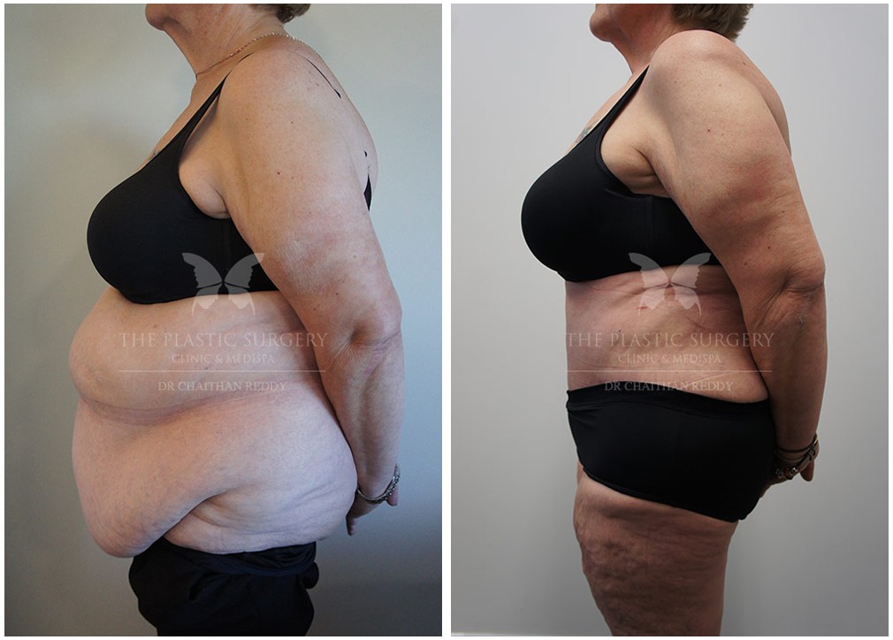 Patient before and after post weight loss surgery 48, Dr Reddy
