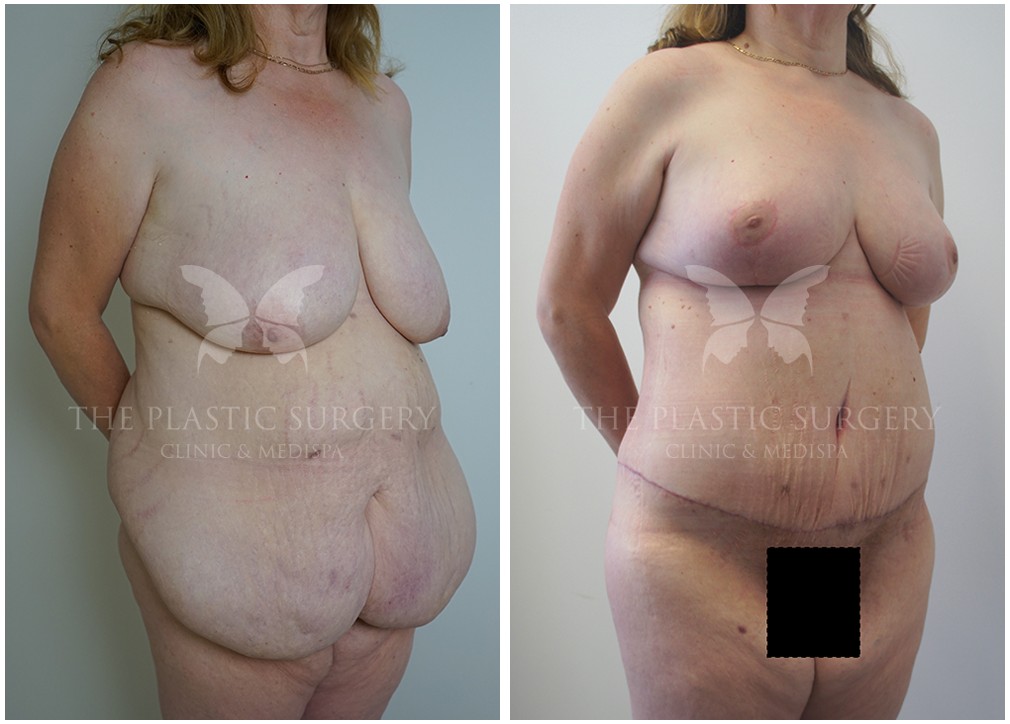 Patient before and after post weight loss surgery 53, TPSC