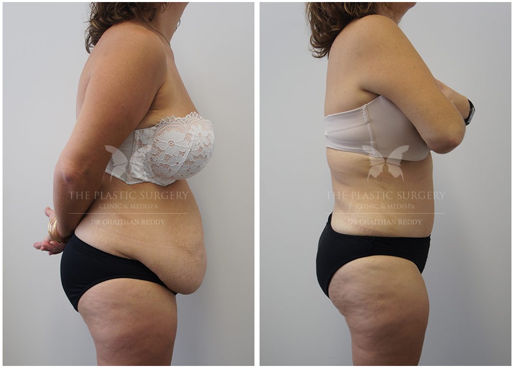Before and after weight loss surgery 56, The Plastic Surgery Clinic