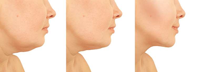 Neck lift surgery patient before and after 01
