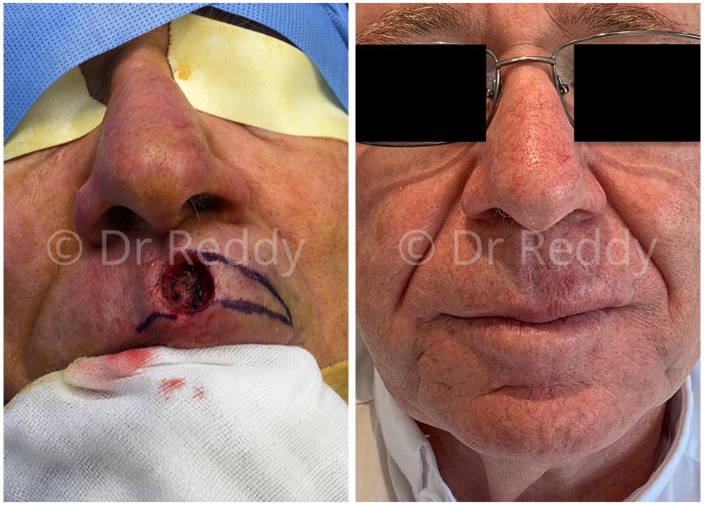 Before and after skin cancer removal 02, front view, male patient, TPSC