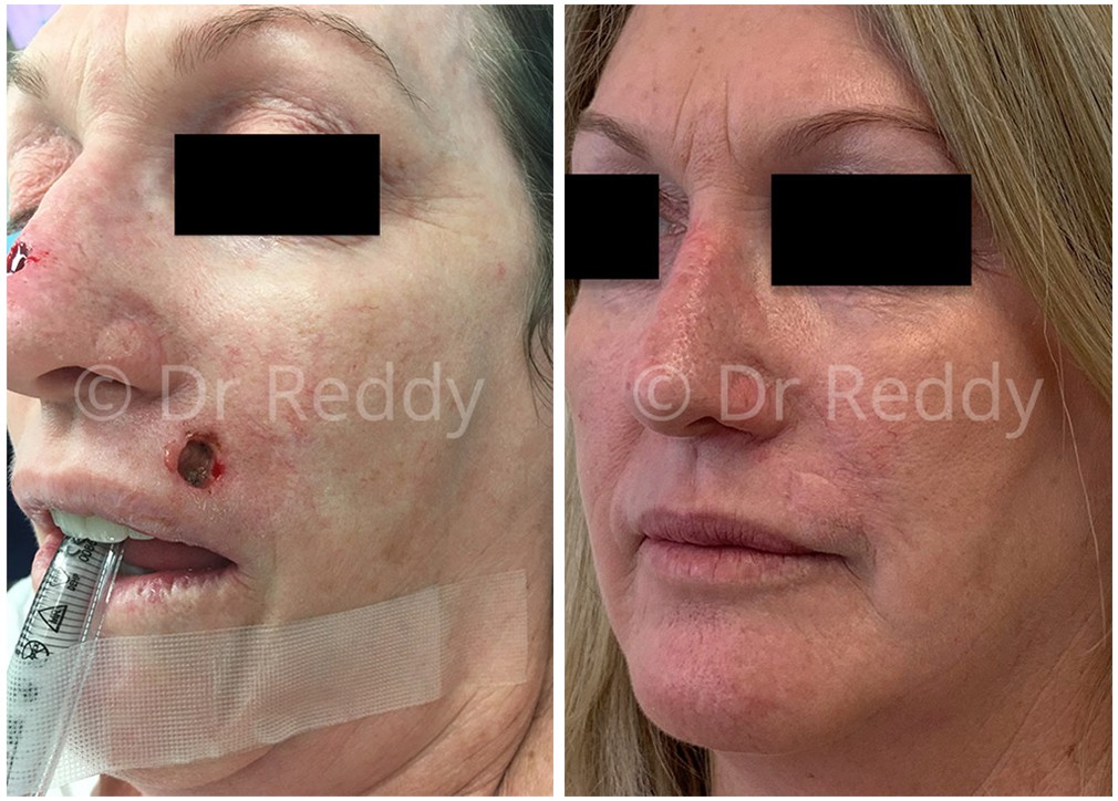 Female patient before and after skin cancer removal 03, TPSC Sydney