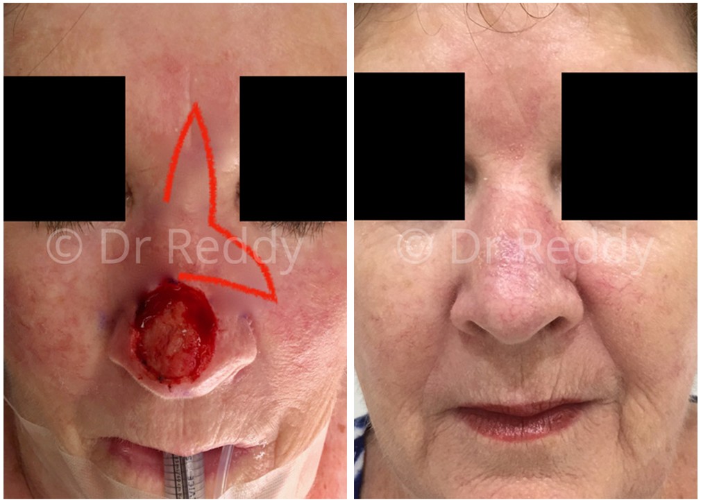 Patient before and after skin cancer removal surgery at The Plastic Surgery Clinic Sydney 05