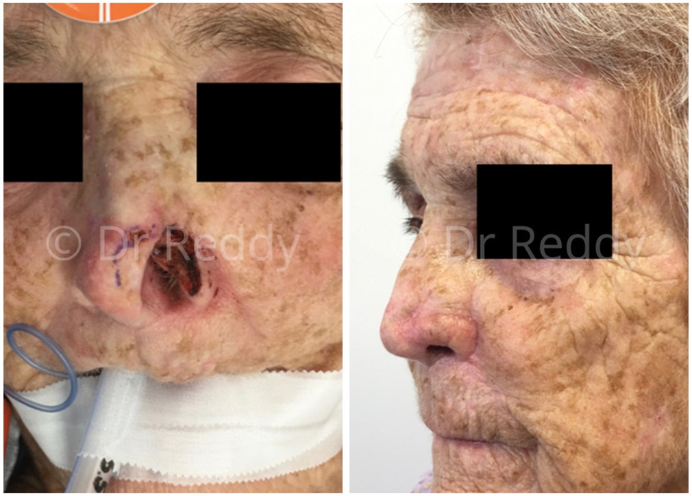 Older female patient before and after skin cancer removal at TPSC 06