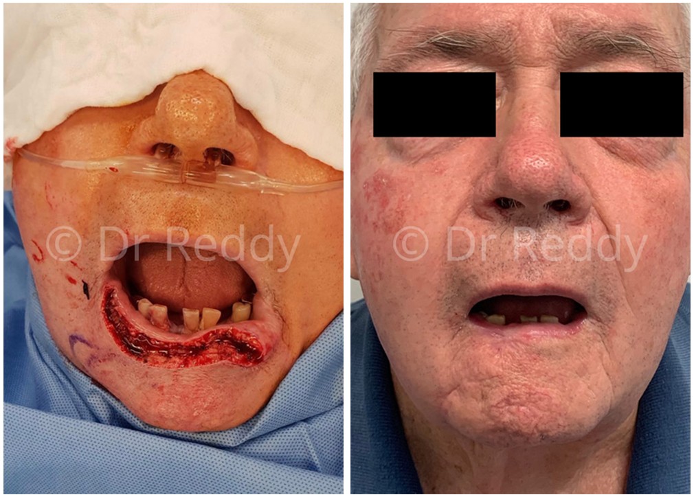 Skin cancer removal before and after 09, lower lip, front view