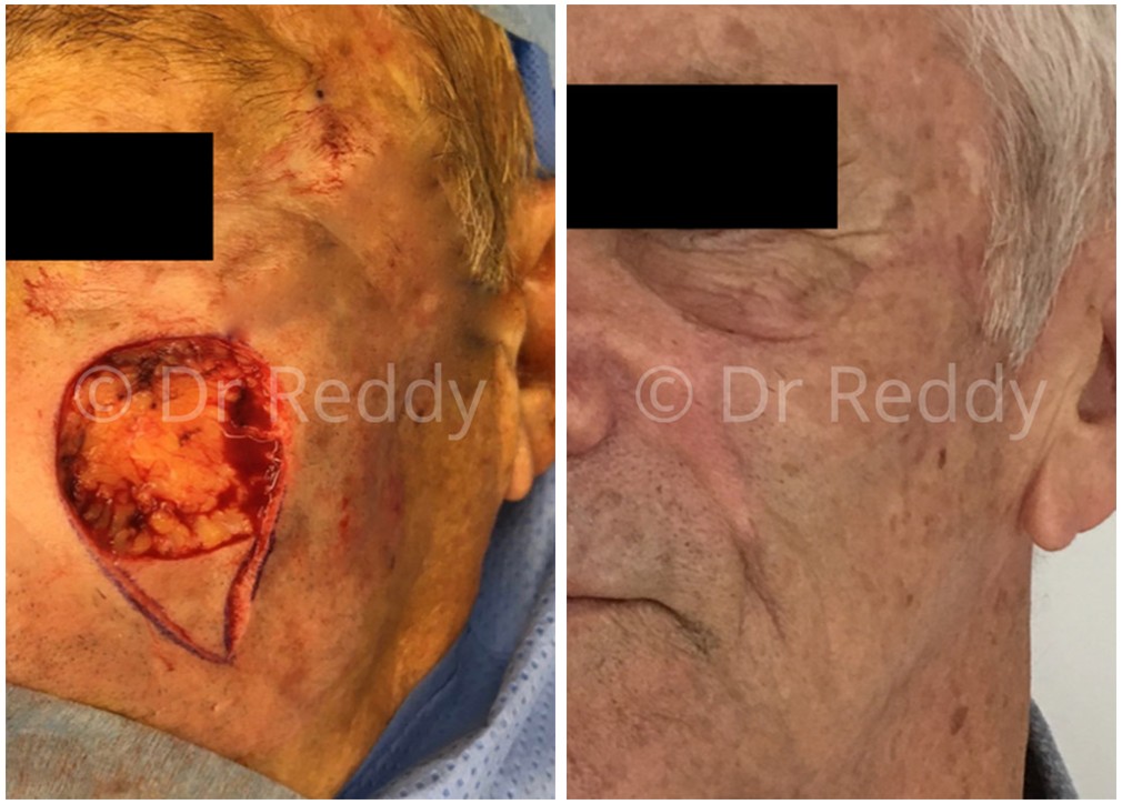 Skin cancer removal from cheek area, before and after 11, Dr Chaithan Reddy