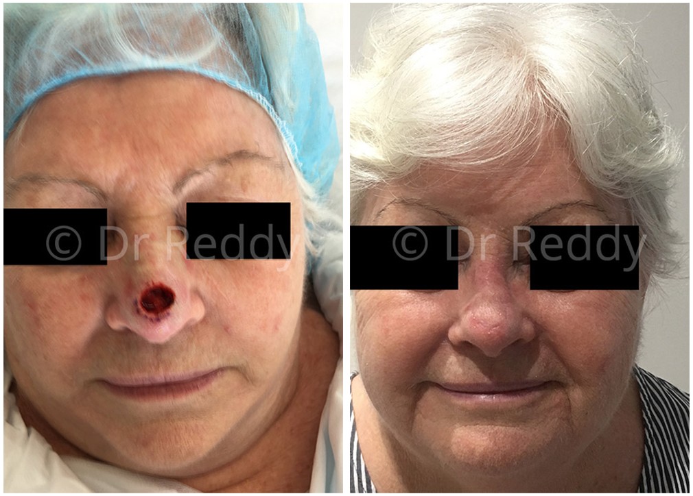 Female patient before skin cancer removal from Nose 14, Dr Reddy Sydney