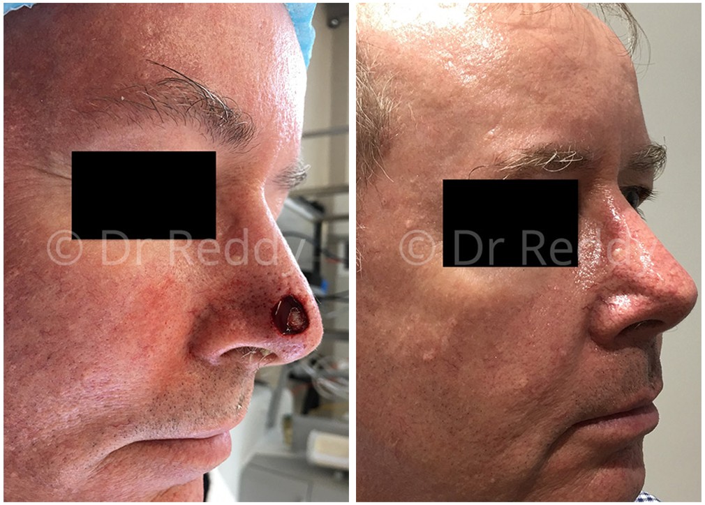 Patient before and after skin cancer removal 15, male, side view, nose area