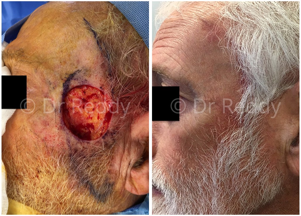 Male patient before and after skin cancer removal surgery 16, TPSC