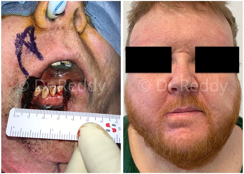 Male patient before and after skin cancer surgery on mouth 18, front view