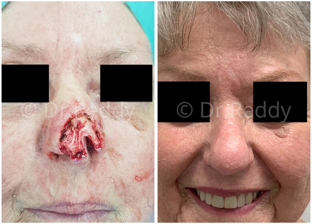 Female patient before and after skin cancer removal surgery 23, top nose area, front view