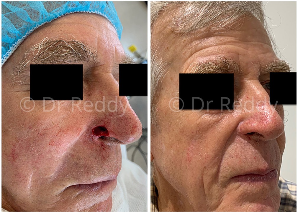 Skin cancer surgery before and after 28, Dr Reddy Sydney