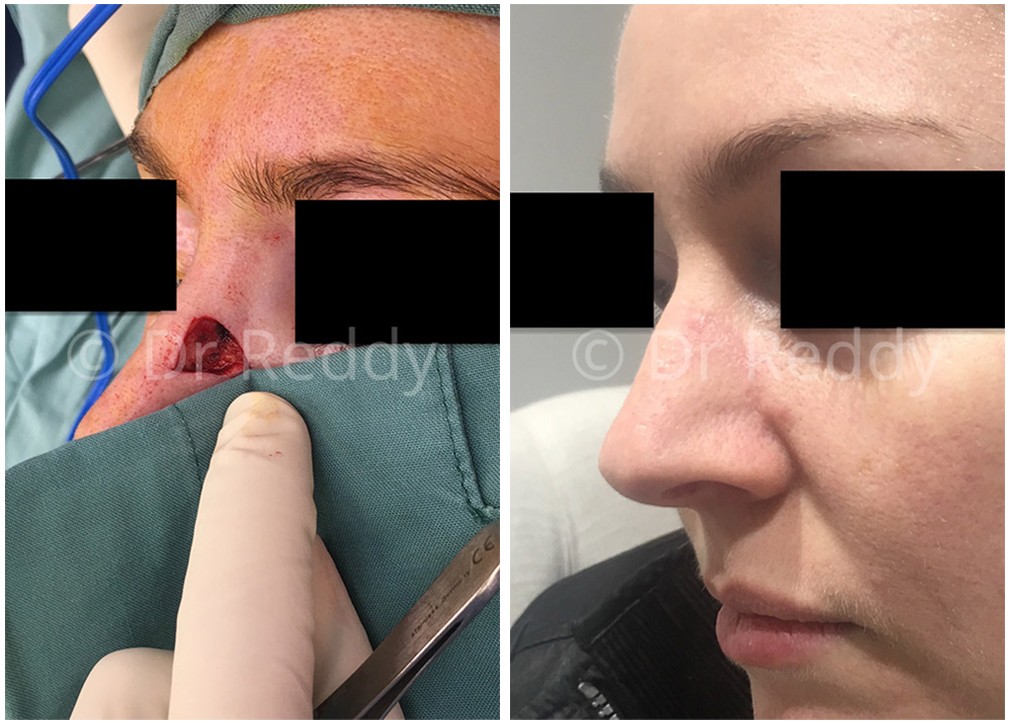 Skin cancer removal before and after 31, TPSC