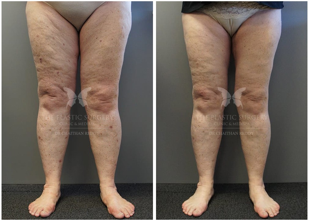 Patient before and after thigh lift 01, TPSC Sydney &amp; Central Coast