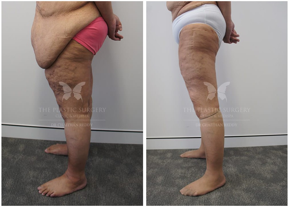 Thigh Lift Scars, What to Expect