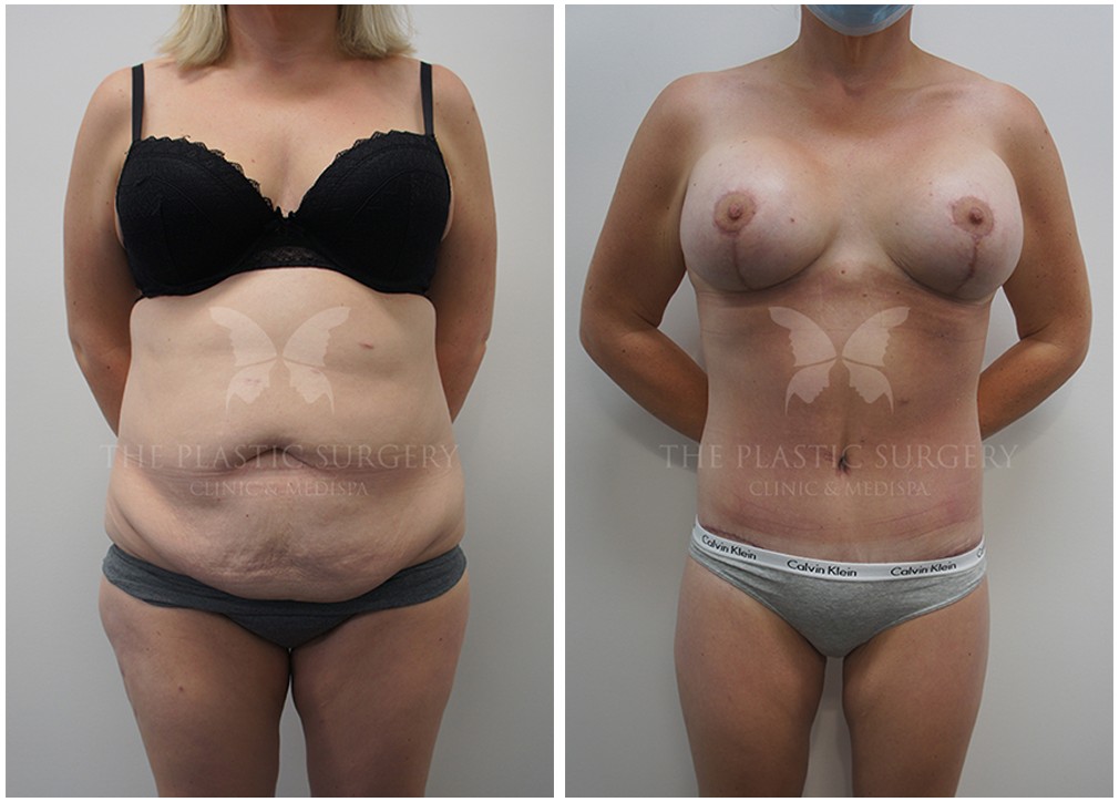Abdominoplasty Gallery | Tummy Tuck Before and After | TPSC